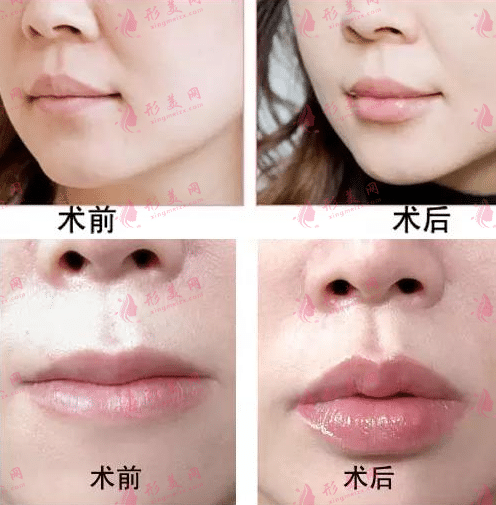 玻尿酸豐唇價(jià)格表？嘟嘟唇怎么樣?怎么做的?