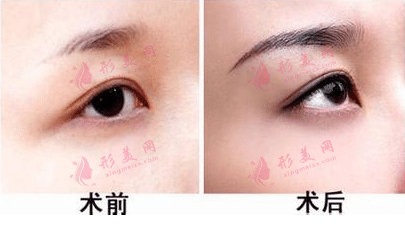 眉毛移植費用多少錢？眉毛移植效果怎么樣？