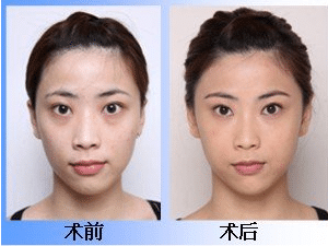 激光去眼袋手術的價格，激光去眼袋手術有什么好處