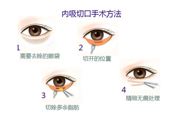 內切祛眼袋是永久的嗎？會復發(fā)嗎？