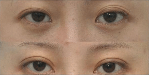 雙眼皮失敗的表現(xiàn)有哪些?雙眼皮修復(fù)成功率高嗎?