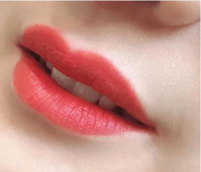 紋唇有哪些手術(shù)方法?如何避免嘴唇發(fā)黑?