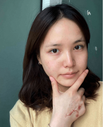 成都軍建醫(yī)院疤痕科怎么樣？附祛疤真人案例一覽