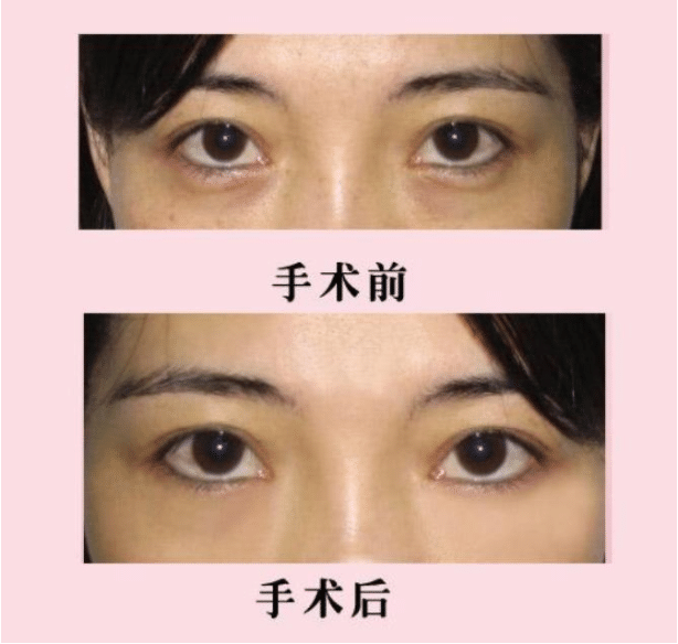 提眉術(shù)前后對比