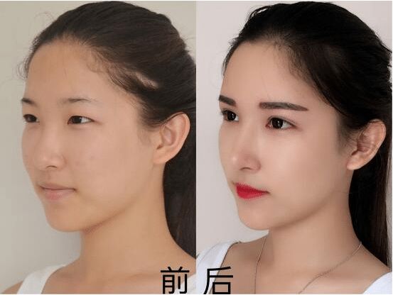 鼻修復