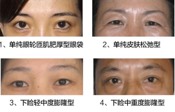 激光溶脂去眼袋有效嗎?去眼袋手術會反彈嗎?