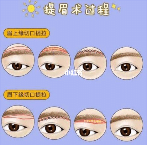 切眉手術(shù)的原理是什么？切眉手術(shù)能解決什么問(wèn)題?