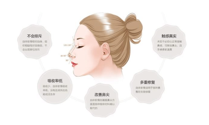 自體軟骨隆鼻的費(fèi)用是多少?自體軟骨隆鼻有哪些種類?