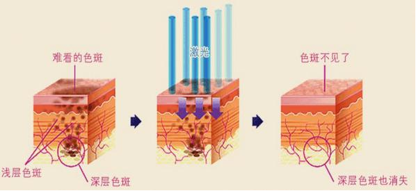 激光祛斑有沒有副作用?能消滅頑固斑塊嗎?