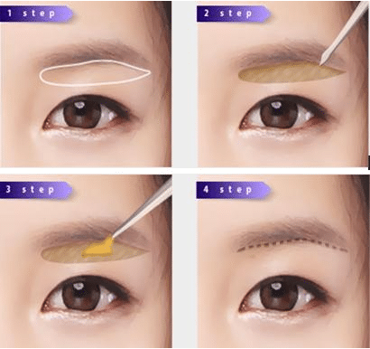 切眉術(shù)和提眉術(shù)有什么不同?區(qū)別具體是什么