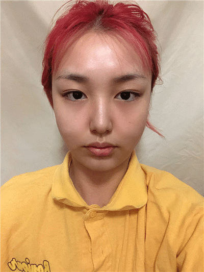 上海九院整形科吸脂效果好嗎?曹衛(wèi)剛案例及價格表給出答案
