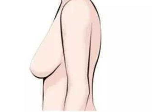 胸下垂矯正手術(shù)好多錢？會不會影響哺乳？