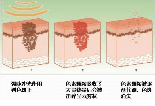 彩光嫩膚后如何保養(yǎng)？彩光嫩膚后的注意事項官網(wǎng)通報