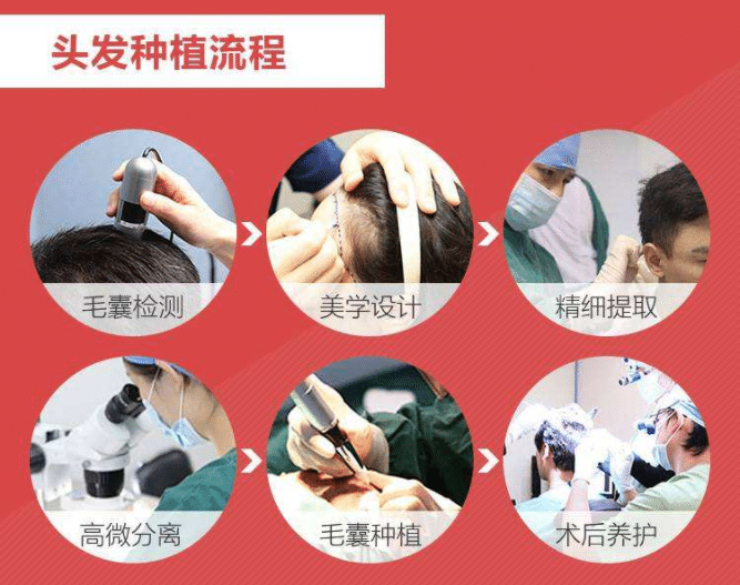頭發(fā)種植多少錢 頭發(fā)種植多少錢