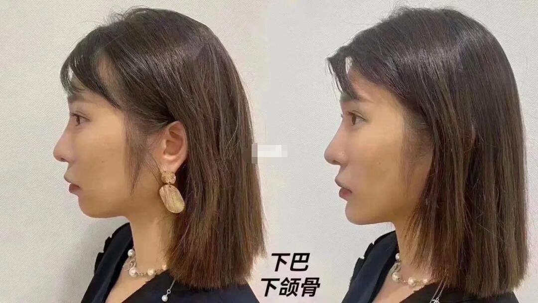 墊下巴