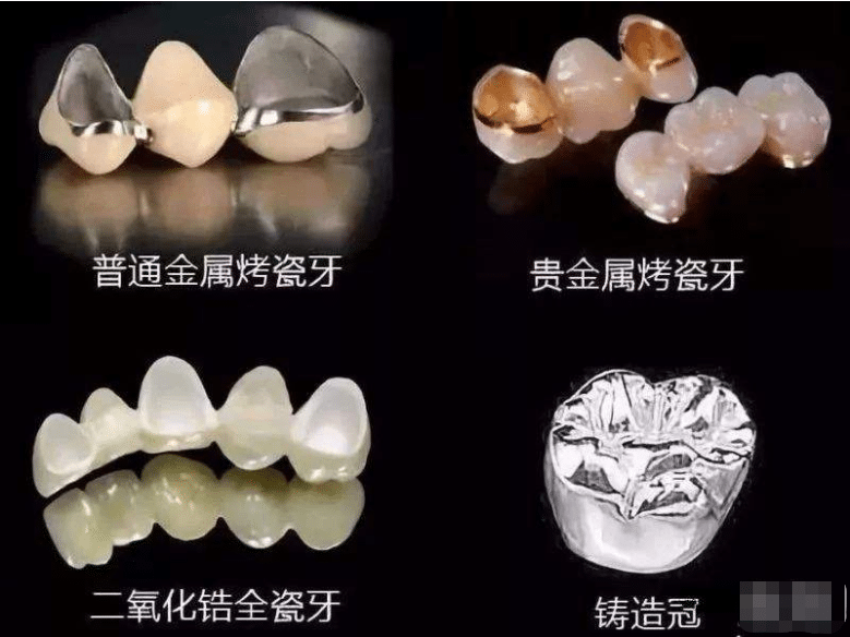 烤瓷牙多少錢一顆？全新價(jià)格表為你揭秘，科普！