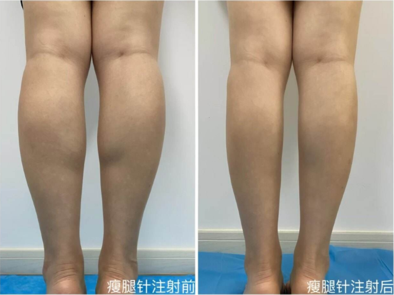 瘦腿針前后對比