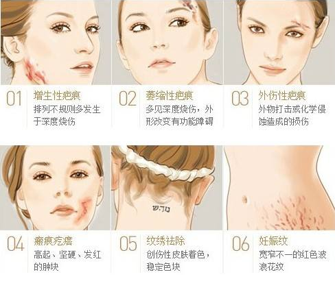 疤痕種類及修復(fù)