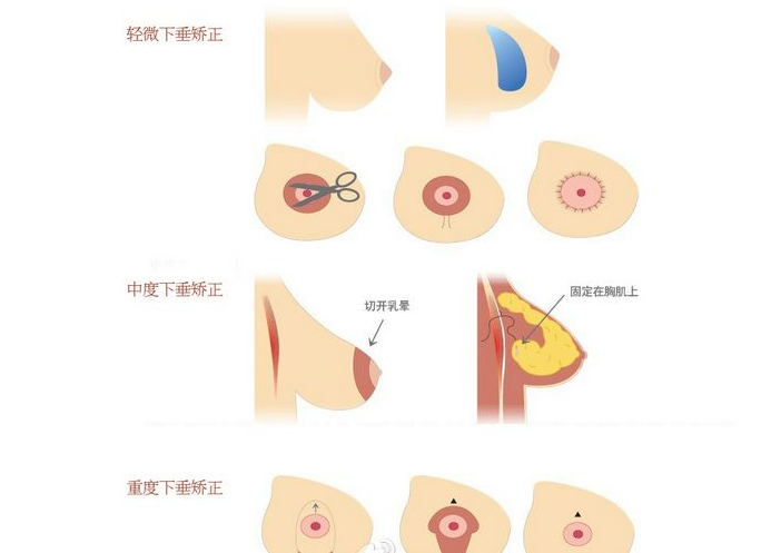 乳房下垂矯正