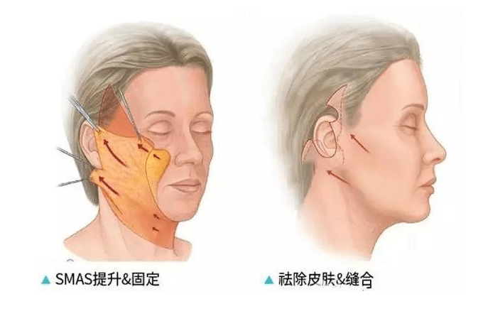 小拉皮手術(shù)