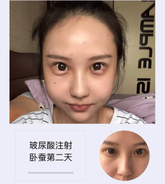 玻尿酸注射臥蠶有多長的恢復期?