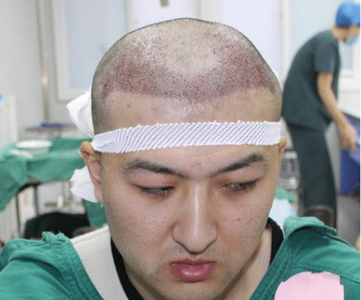 上海植發(fā)價格多少?植發(fā)后頭發(fā)還會再掉嗎?