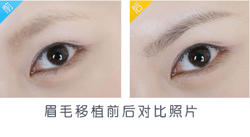 眉毛的價(jià)格一般是多少?種植眉毛可以維持多長時(shí)間