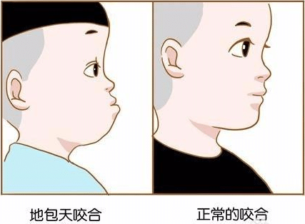 地包天能不能矯正過來呢?地包天是如何形成的?