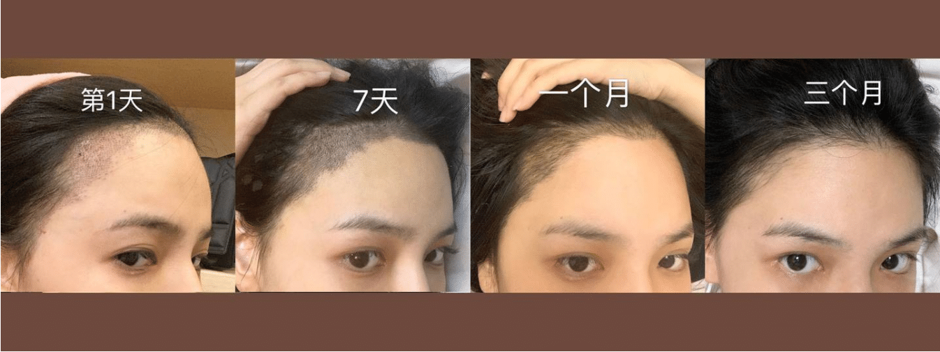 植發(fā)需要多少錢
