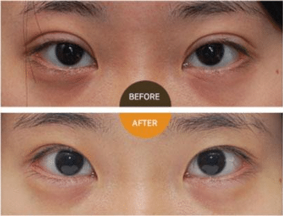 雙眼皮修復(fù)多少錢