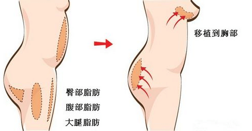 自體脂肪隆胸效果怎么樣？存活率高不高