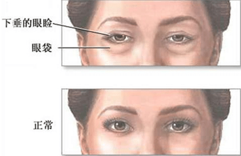 抽脂去眼袋手術(shù)