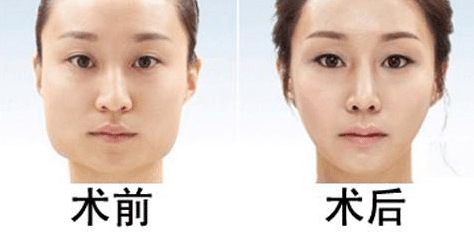 磨骨手術(shù)前后對比 磨骨手術(shù)前后對比