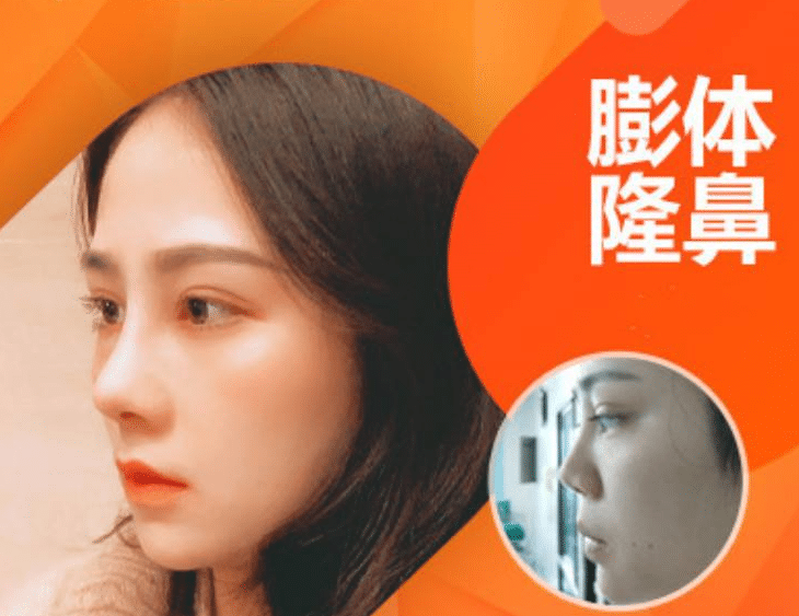 膨體隆鼻