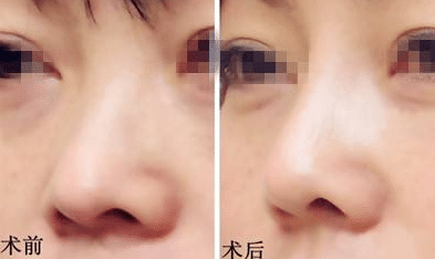 膨體隆鼻前后對(duì)比