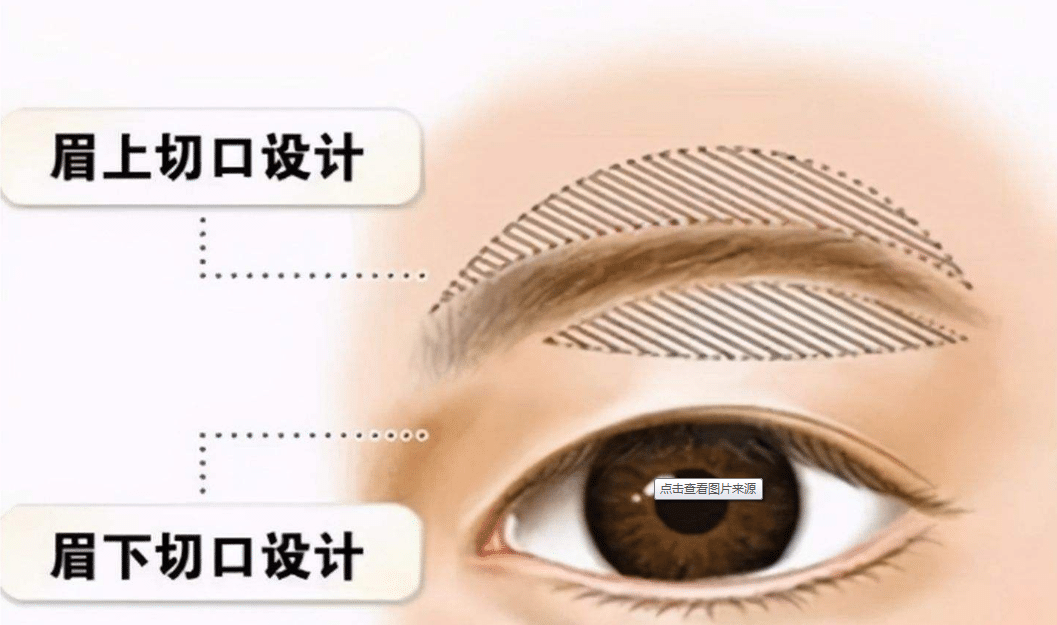 提眉手術(shù)的價(jià)格是多少？效果怎么樣？
