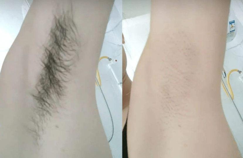 永久性脫毛前后對比