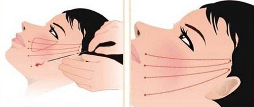 面部埋線
