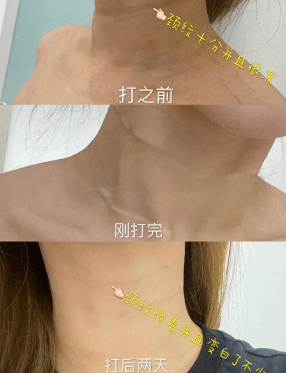 去頸紋前后對比