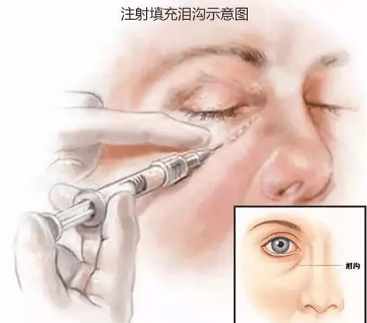 膠原蛋白填充淚溝 膠原蛋白填充淚溝