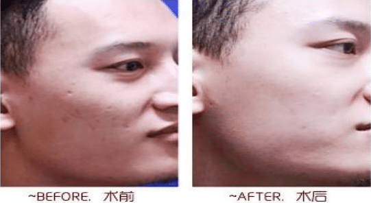 鐳射凈膚前后對(duì)比 鐳射凈膚前后對(duì)比