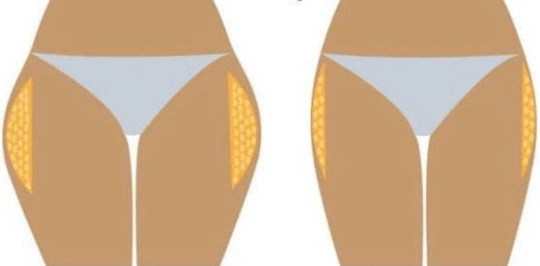 大腿外側(cè)抽脂前后對比