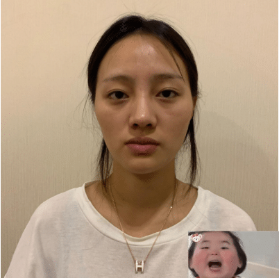 北京新星靚做面部脂肪填充效果好不好？