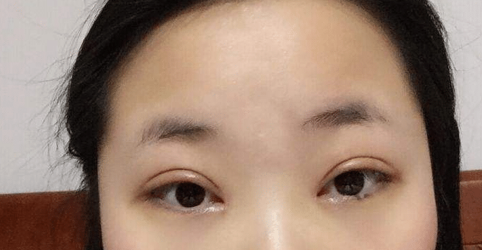 全切雙眼皮肉條