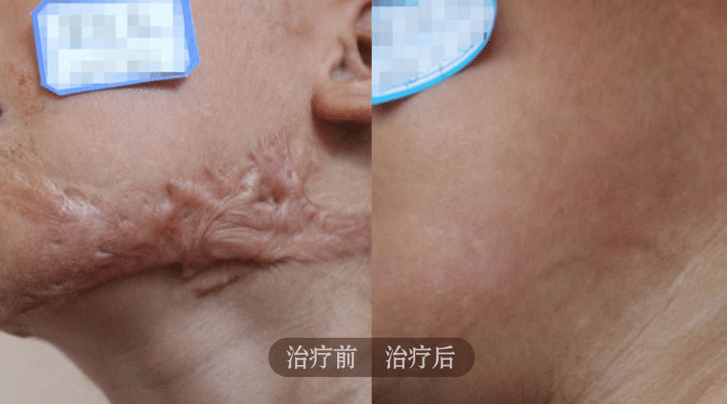 疤痕修復(fù)
