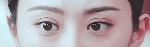 雙眼皮