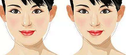 脂肪型雙下巴