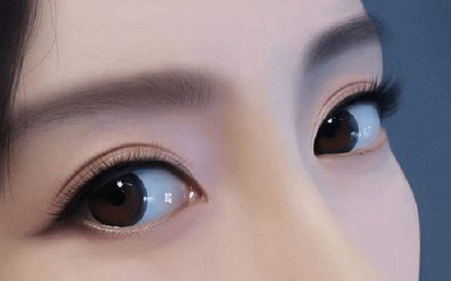 為什么雙眼皮手術(shù)會失?。咳绾伪苊飧铍p眼皮失敗?