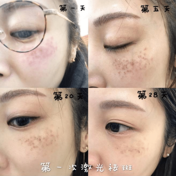 激光祛斑效果怎么樣?激光祛斑后的六大禁忌!