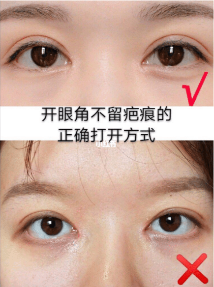 開(kāi)眼角